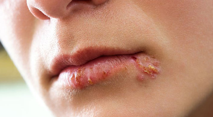 শীতের যন্ত্রণা জ্বর ঠোসা!